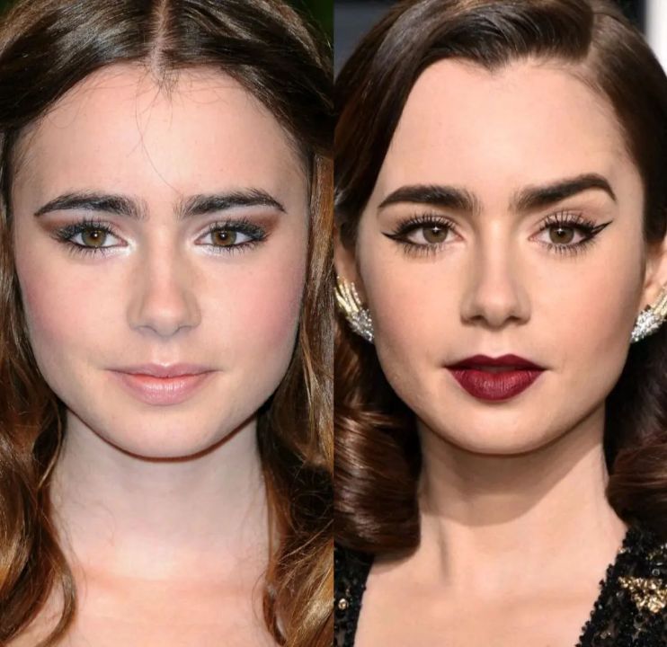 Lily Collins before and after subtle plastic surgery.