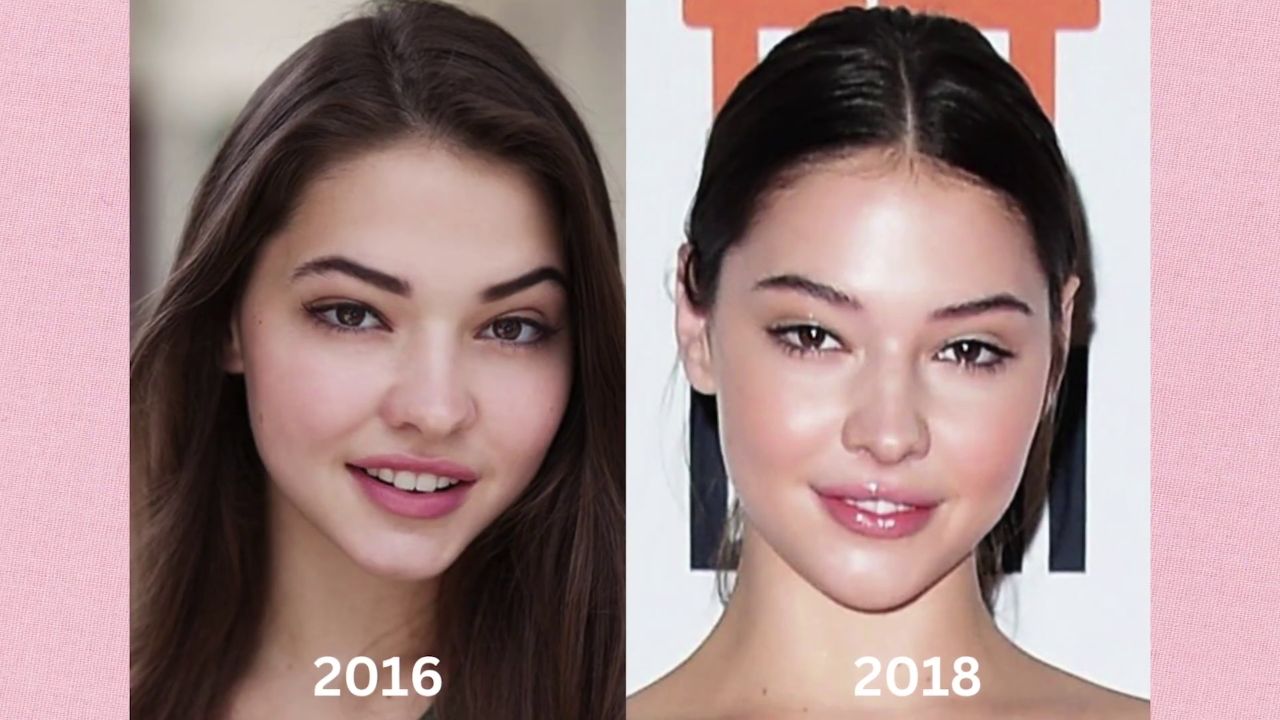 Madelyn Cline's lip fillers started getting more noticed from 2018 onwards.